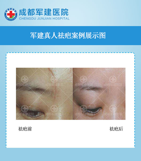 修复疤痕案例